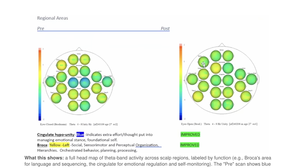 Regional theta QEEG maps before and after the 30-day intervention