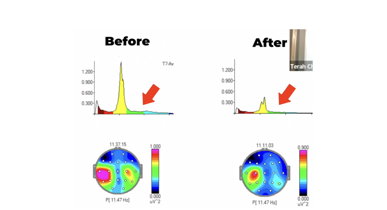 T7 spectral and topographic displays before and after the intervention